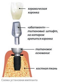 Установки ионной имплантации схема