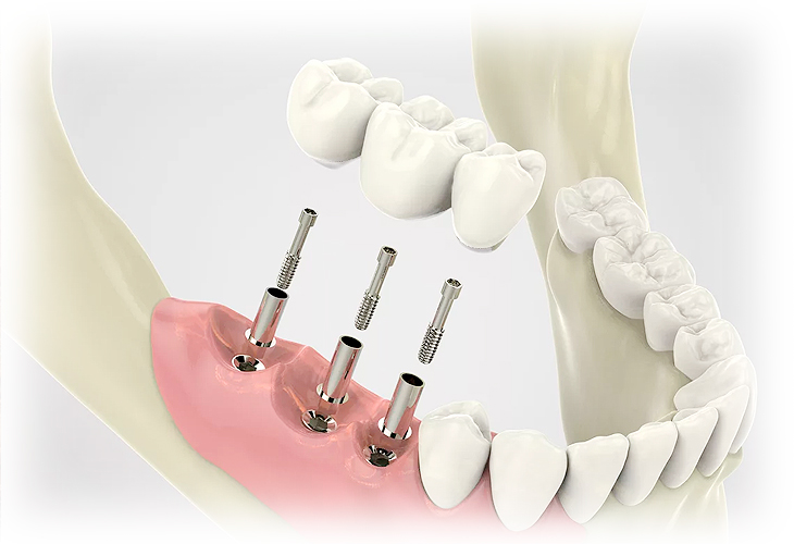 Зубной имплантат фото