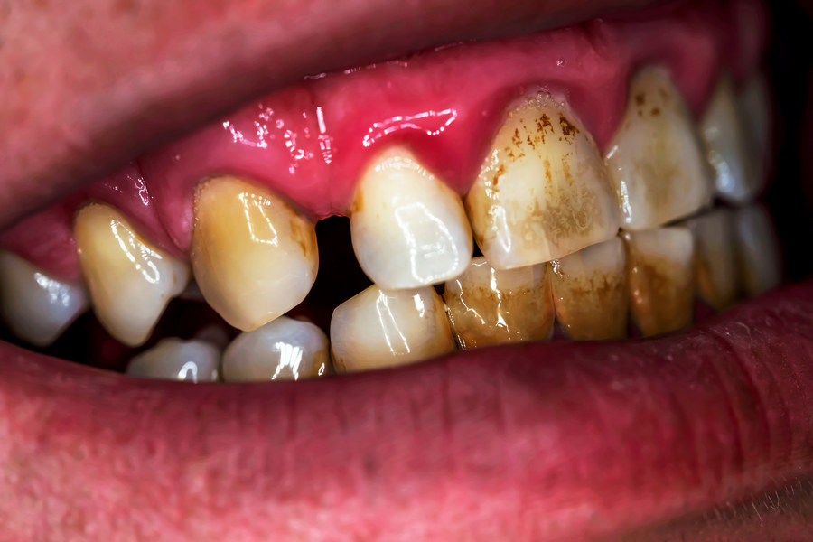 Как удалить черные пятна на зубах?