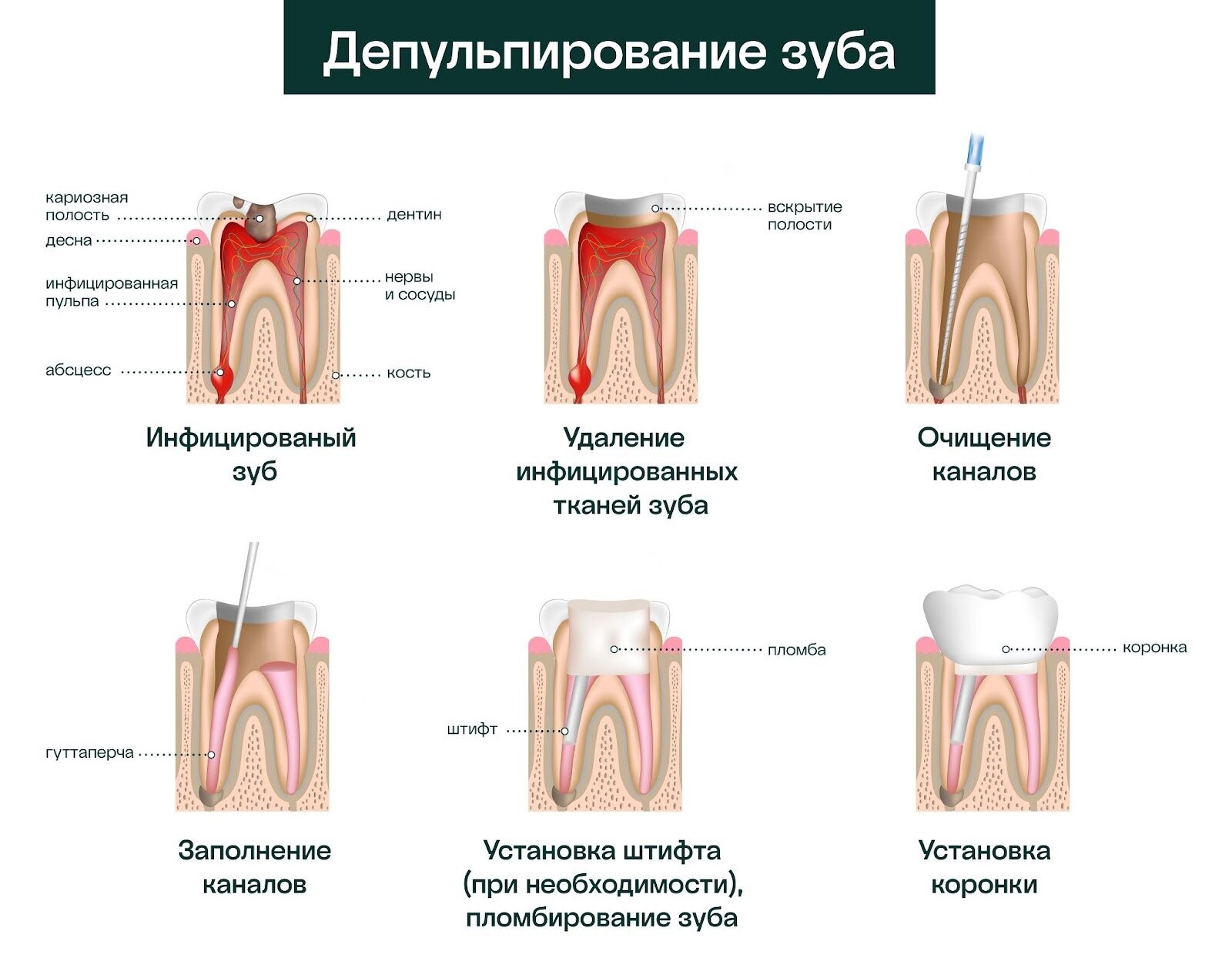 депульпирование зуба