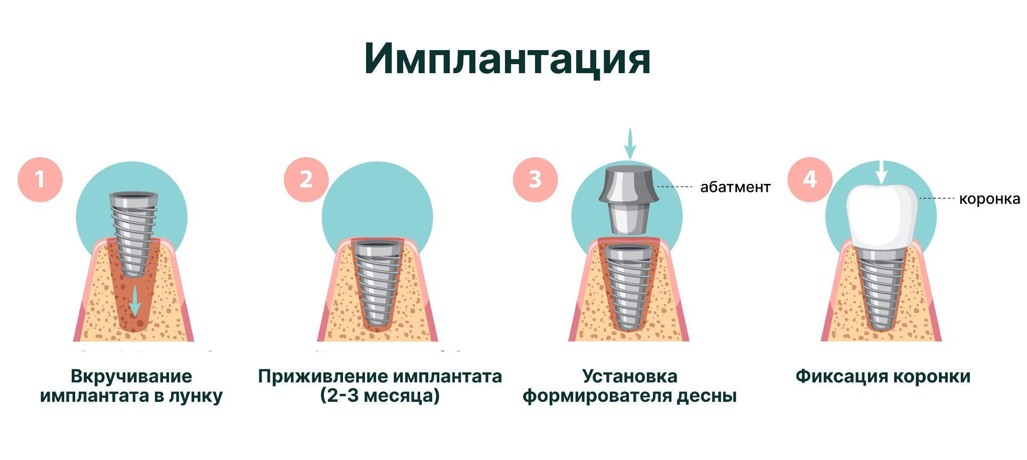 этапы имплантации