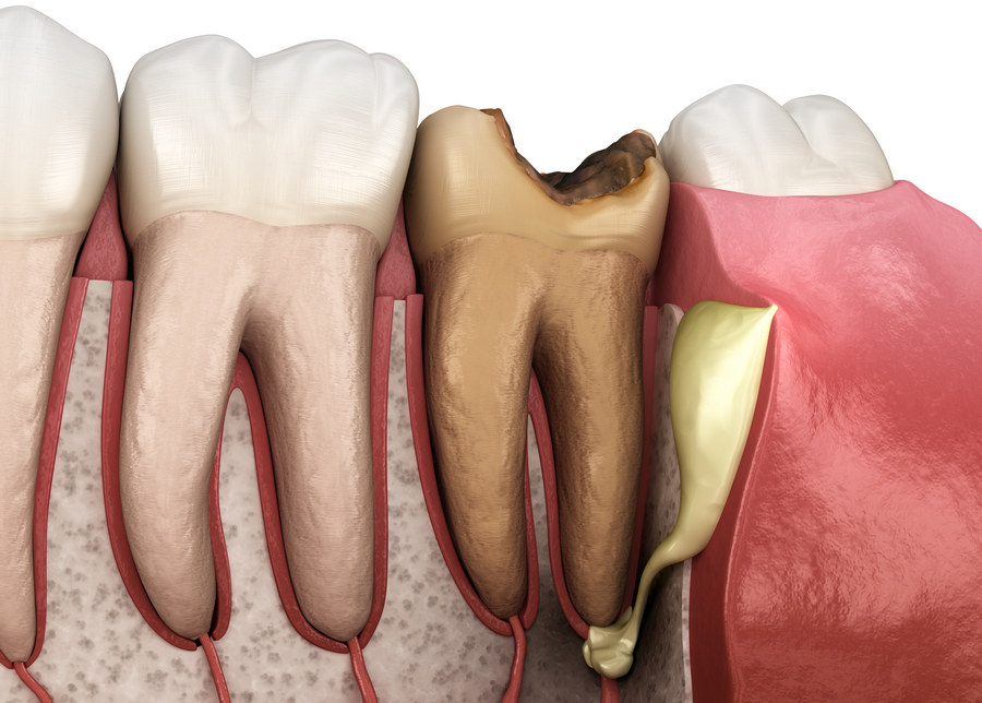 Температура при прорезывании зубов: причины, продолжительность | Стоматология Космодента