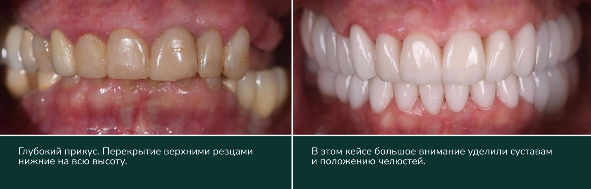 Лечение глубокого прикуса: до и после. Кейс сети клиник ПрезиДЕНТ