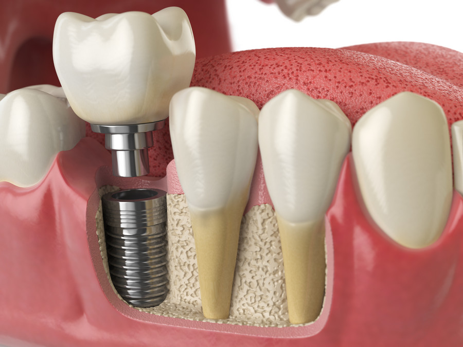 Подготовка к имплантации зуба: практические рекомендации и предостережения