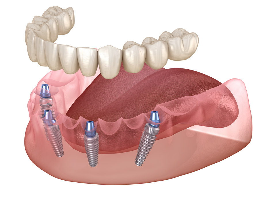 Имплантация нескольких зубов