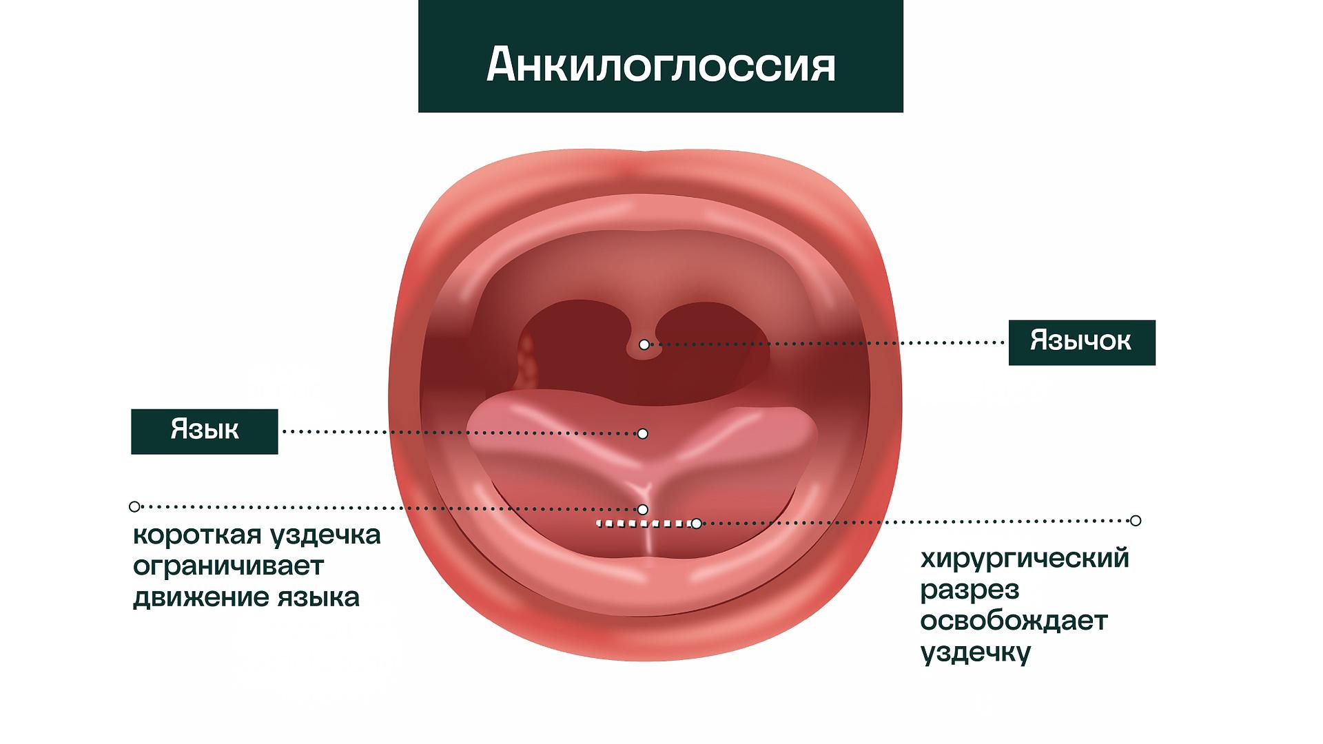 Как подрезают уздечку - 1