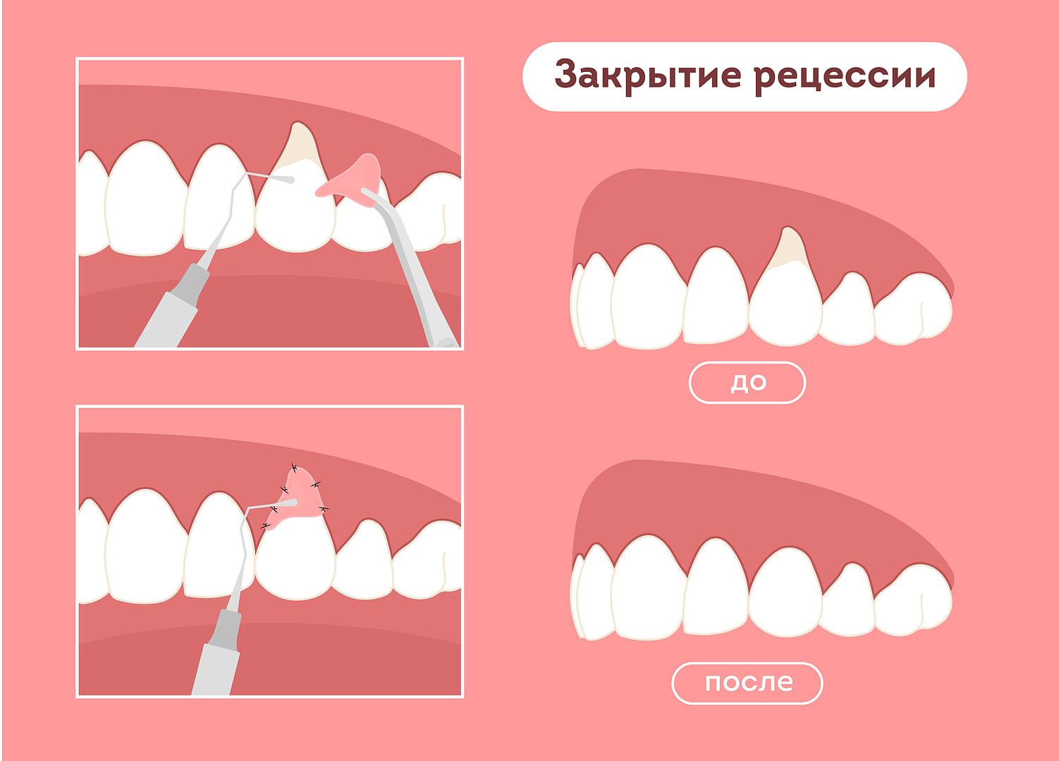 Процесс закрытия клиновидного дефекта