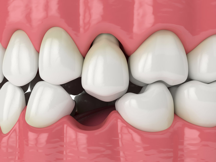 Как лучше укрепить шатающийся зуб дома
