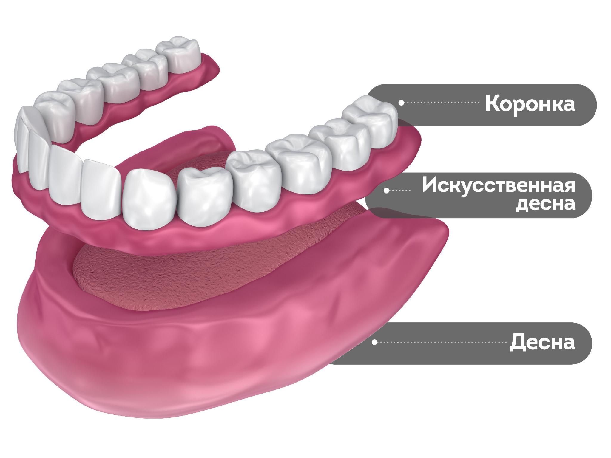 схема установки съемных зубных протезов всей челюсти