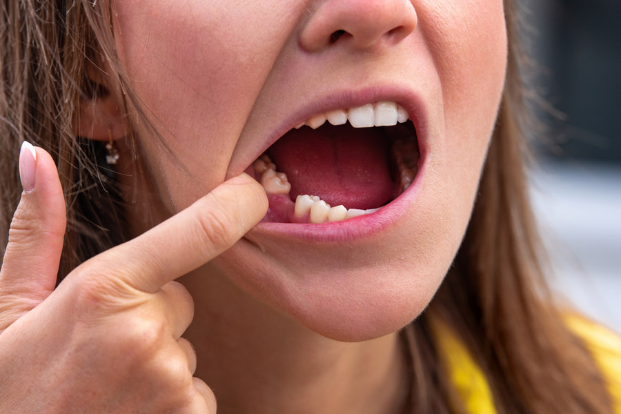 Что делать, если болит десна после удаления зуба?