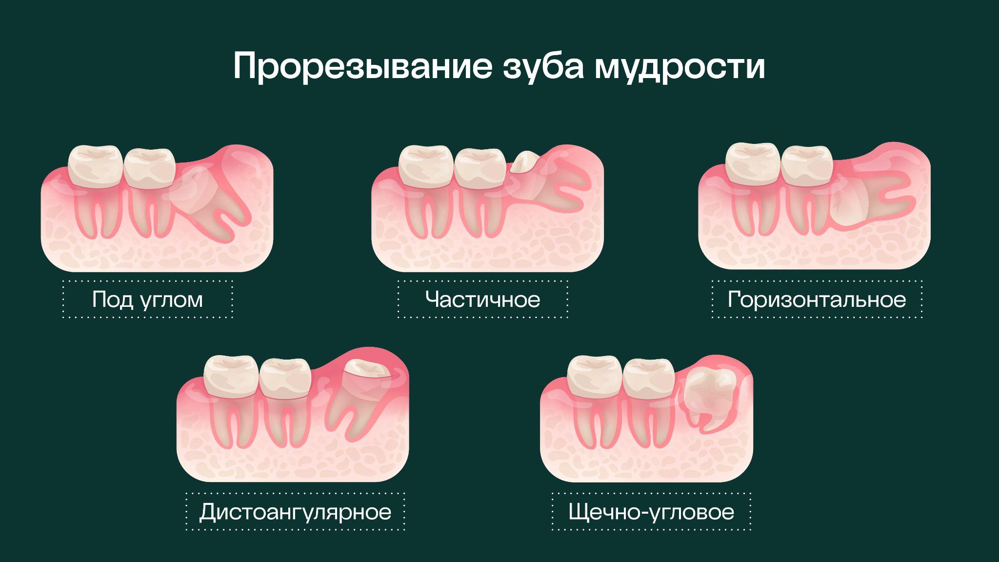 Когда растет зуб мудрости