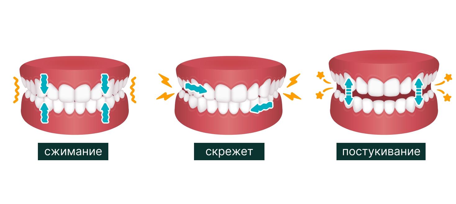 виды бруксизма