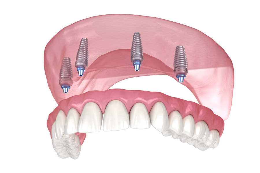 Зубы на 4 имплантах